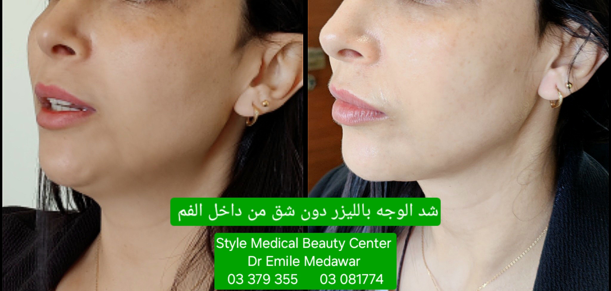 Facial rejuvenation with intraoral laser lift Beirut