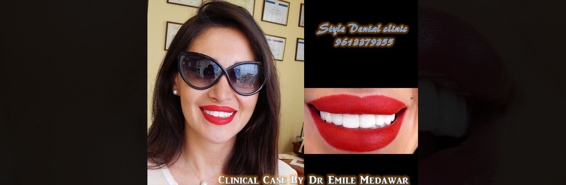 dental implants lebanon