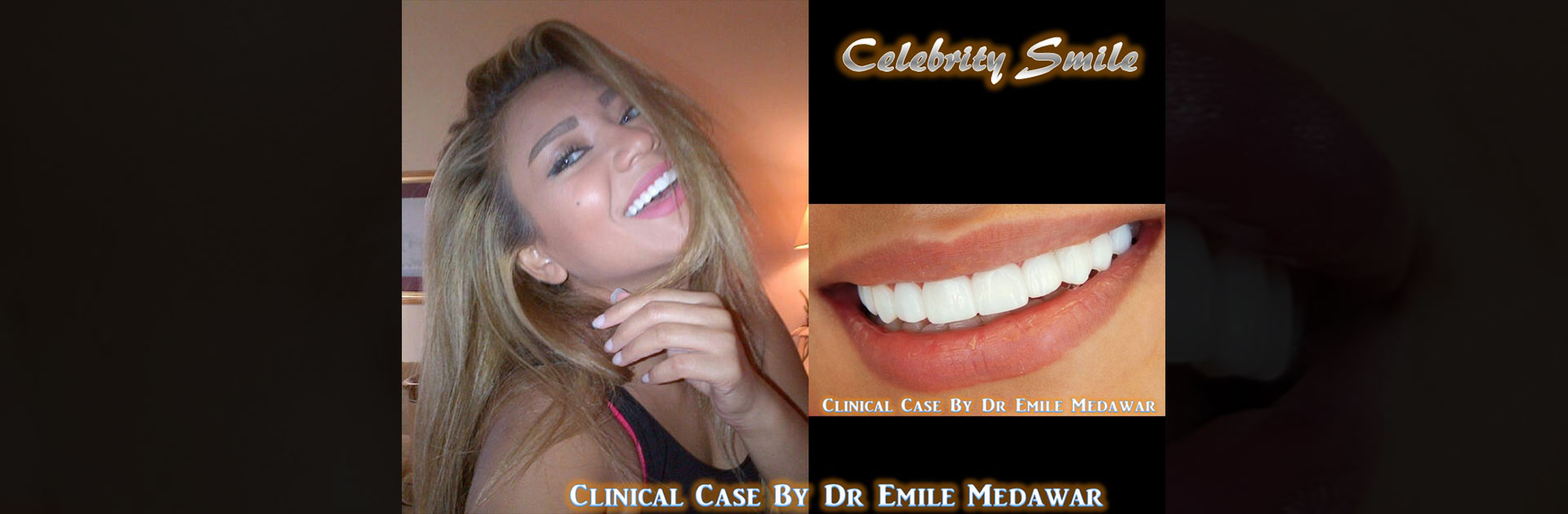 dental implants beirut